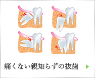 親痛くない親知らずの抜歯