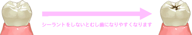 シーラントをしないと虫歯に