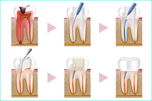 歯の神経の治療（根管治療）