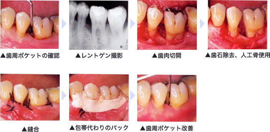 歯周外科手術（重度歯周病の方対象）