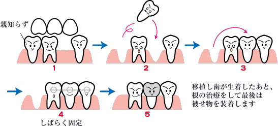 親知らずの移植